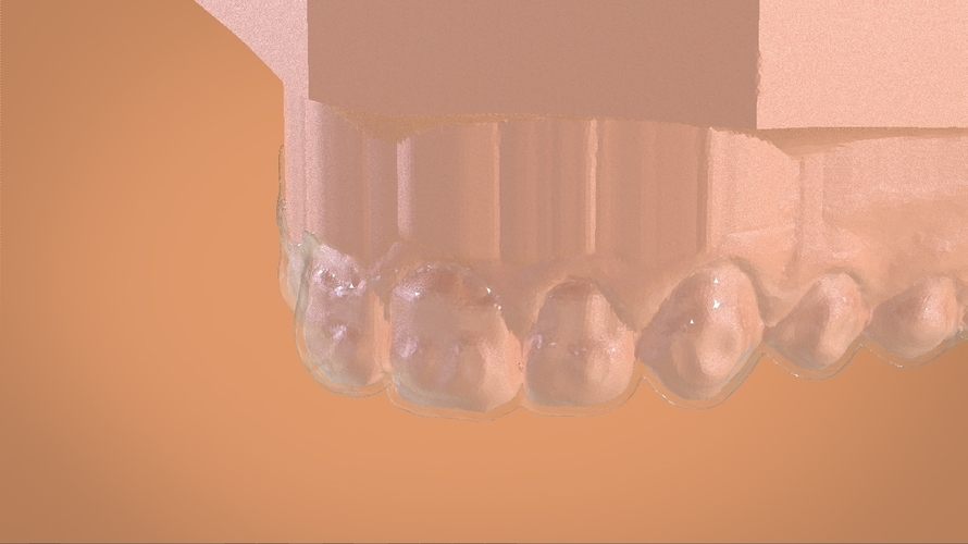 Digital Dental Bleaching Tray 3D Print 160375 Digital Dental Bleaching Tray 3D Print 160375