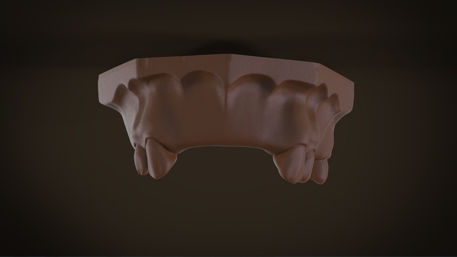 Digital Removable Partial Denture Framework 3D Print 160812 Digital Removable Partial Denture Framework 3D Print 160812