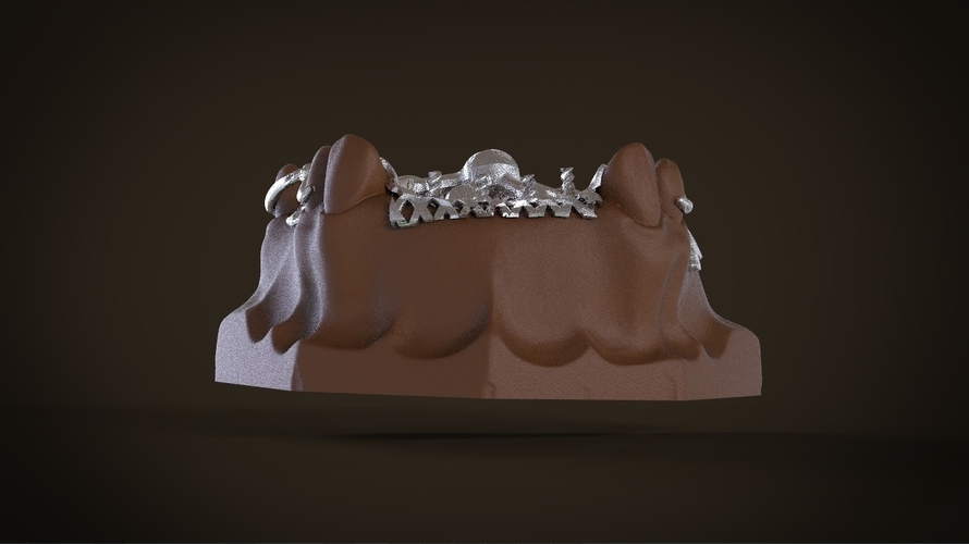 Digital Removable Partial Denture Framework 3D Print 160815 Digital Removable Partial Denture Framework 3D Print 160815
