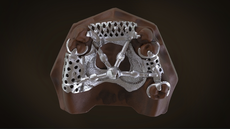 Digital Removable Partial Denture Framework 3D Print 160817 Digital Removable Partial Denture Framework 3D Print 160817
