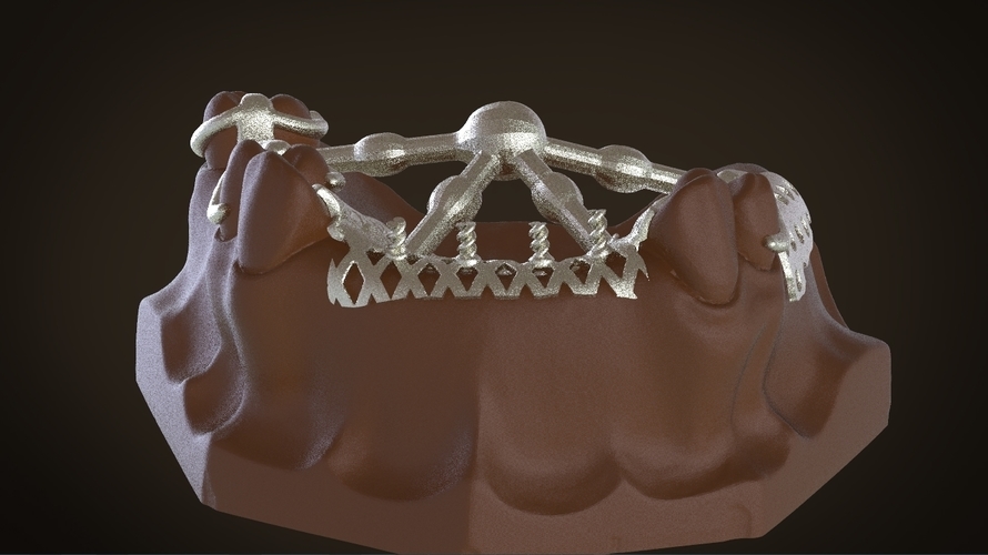 Digital Removable Partial Denture Framework 3D Print 160820 Digital Removable Partial Denture Framework 3D Print 160820