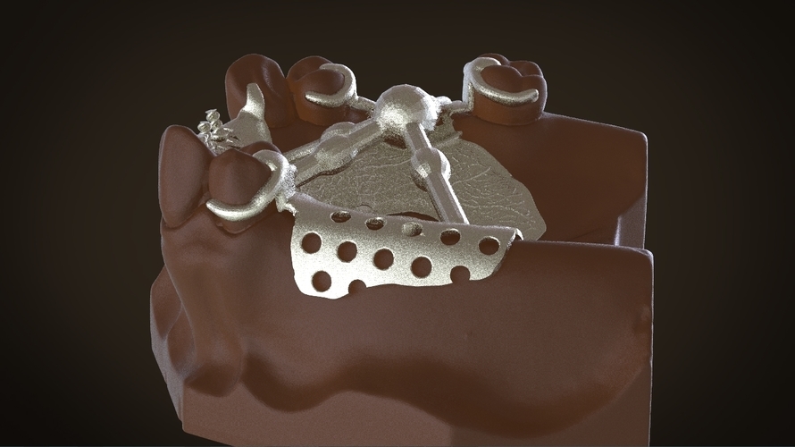 Digital Removable Partial Denture Framework 3D Print 160821 Digital Removable Partial Denture Framework 3D Print 160821