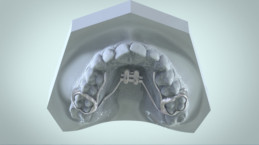 Digital Rapid Palatal Expander 3D Print 161012 Digital Rapid Palatal Expander 3D Print 161012