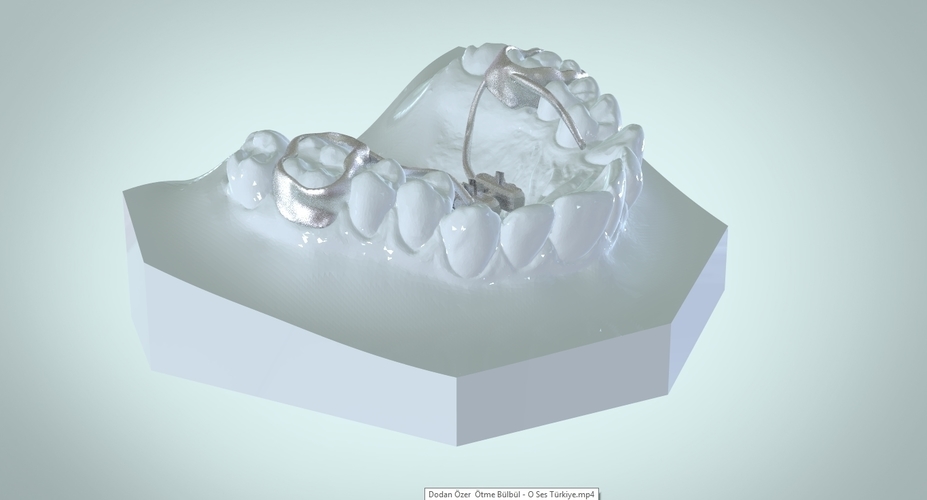 Digital Rapid Palatal Expander 3D Print 161013 Digital Rapid Palatal Expander 3D Print 161013