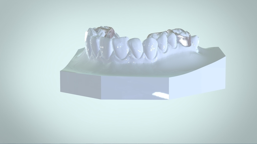 Digital Rapid Palatal Expander 3D Print 161015 Digital Rapid Palatal Expander 3D Print 161015