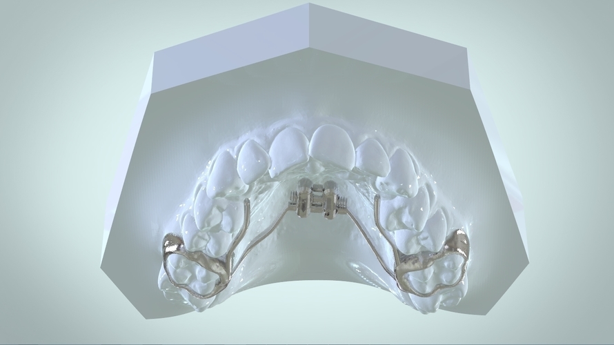Digital Rapid Palatal Expander 3D Print 161017 Digital Rapid Palatal Expander 3D Print 161017