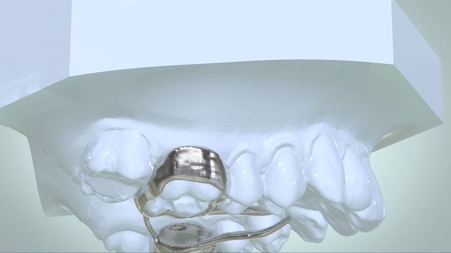 Digital Rapid Palatal Expander 3D Print 161018 Digital Rapid Palatal Expander 3D Print 161018