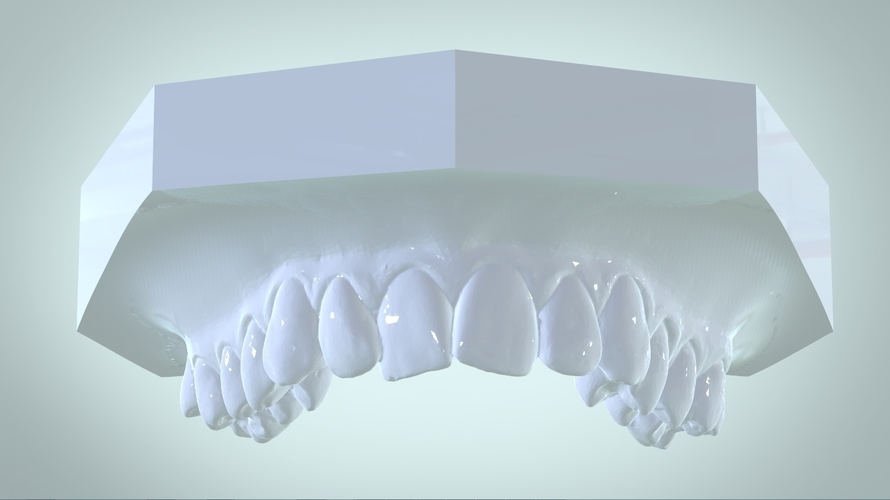 Digital Rapid Palatal Expander 3D Print 161019 Digital Rapid Palatal Expander 3D Print 161019