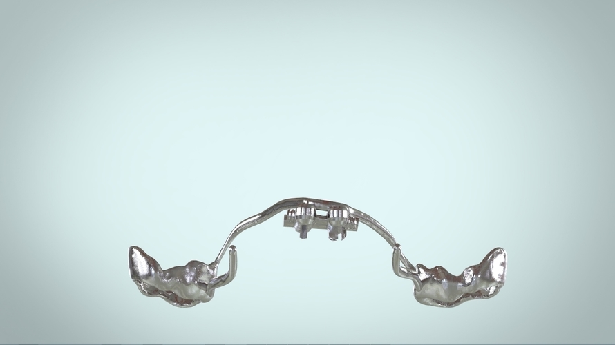 Digital Rapid Palatal Expander 3D Print 161020 Digital Rapid Palatal Expander 3D Print 161020