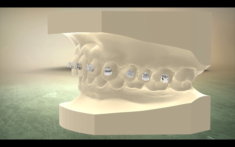 Digital Orthodontic Model with Brackets 3D Print 16583 Digital Orthodontic Model with Brackets 3D Print 16583