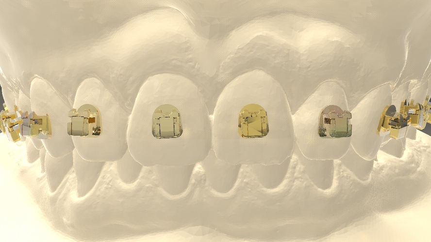 Digital Orthodontic Model with Brackets 3D Print 16586 Digital Orthodontic Model with Brackets 3D Print 16586