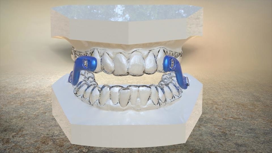 Digital Sleep Apnea Mouthguard 3D Print 17273 Digital Sleep Apnea Mouthguard 3D Print 17273