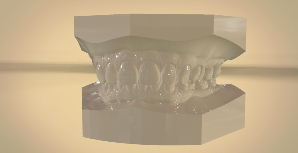 Digital Orthodontic Study Models with Virtual Bases 3D Print 191769 Digital Orthodontic Study Models with Virtual Bases 3D Print 191769