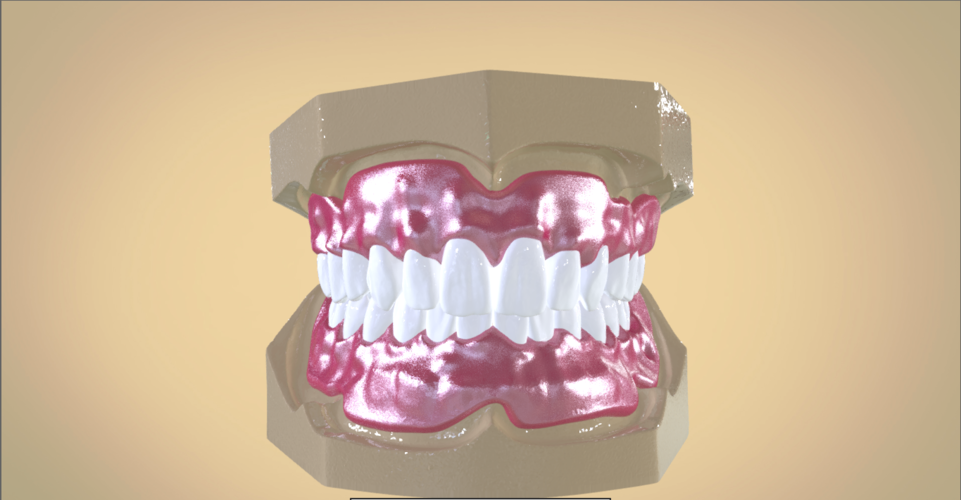 Digital Full Dentures 3D Print 192456 Digital Full Dentures 3D Print 192456