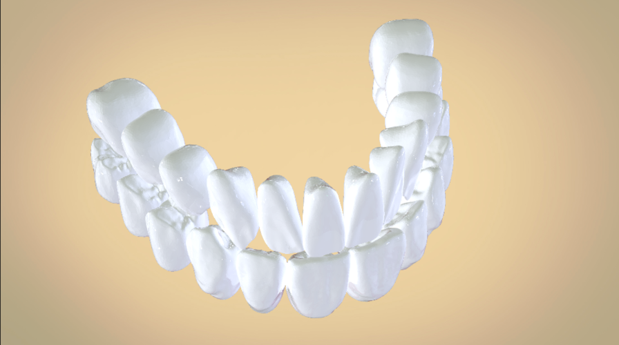 Digital Full Dentures 3D Print 192457 Digital Full Dentures 3D Print 192457