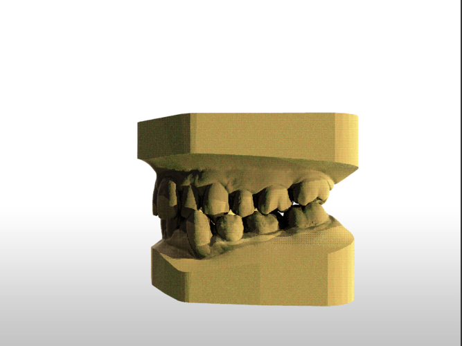 Digital Study Orthodontic Models with Archman Virtual Bases 3D Print 193987 Digital Study Orthodontic Models with Archman Virtual Bases 3D Print 193987