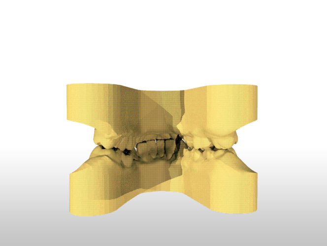 Digital Study Orthodontic Models with Archman Virtual Bases 3D Print 193989 Digital Study Orthodontic Models with Archman Virtual Bases 3D Print 193989