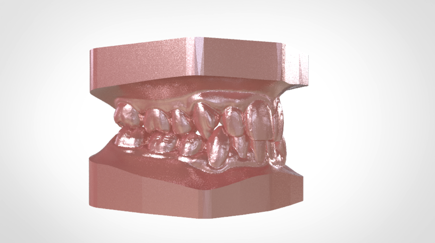 Digital Study Orthodontic Models with Archman Virtual Bases 3D Print 193993 Digital Study Orthodontic Models with Archman Virtual Bases 3D Print 193993