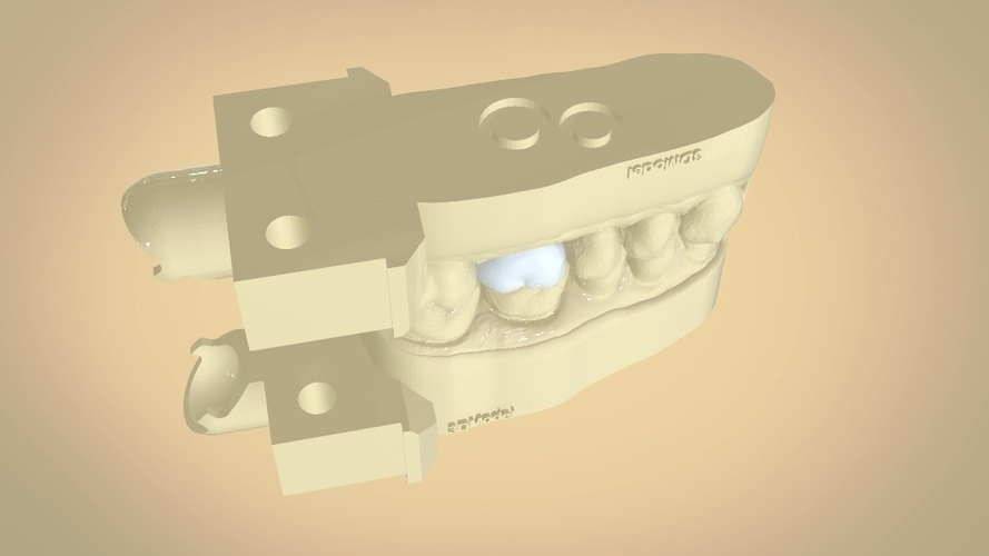Digital Dental Quadrant Model with a Full Contour Crown 3D Print 199156 Digital Dental Quadrant Model with a Full Contour Crown 3D Print 199156
