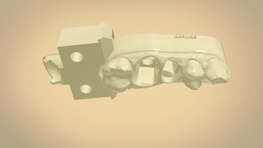 Digital Dental Quadrant Model with a Full Contour Crown 3D Print 199160 Digital Dental Quadrant Model with a Full Contour Crown 3D Print 199160