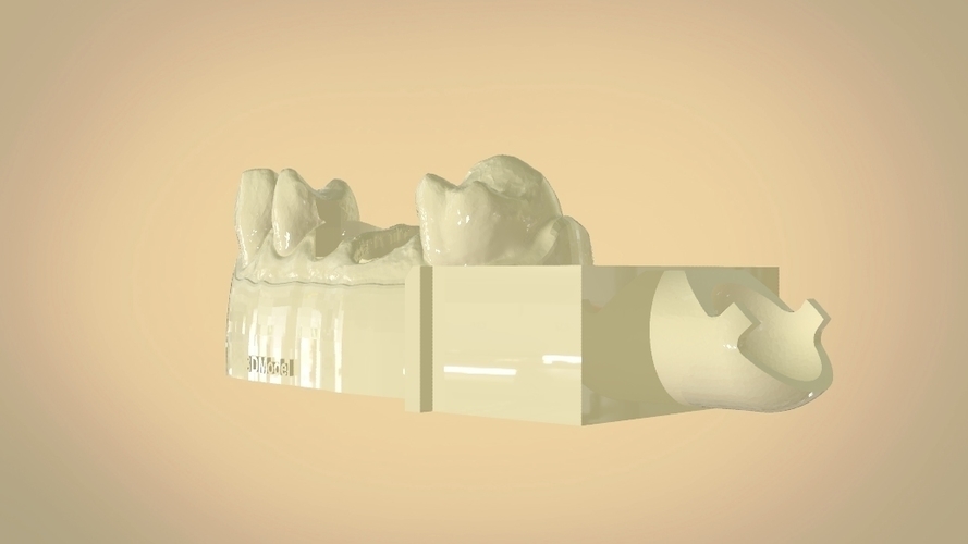 Digital Dental Quadrant Model with a Full Contour Crown 3D Print 199162 Digital Dental Quadrant Model with a Full Contour Crown 3D Print 199162