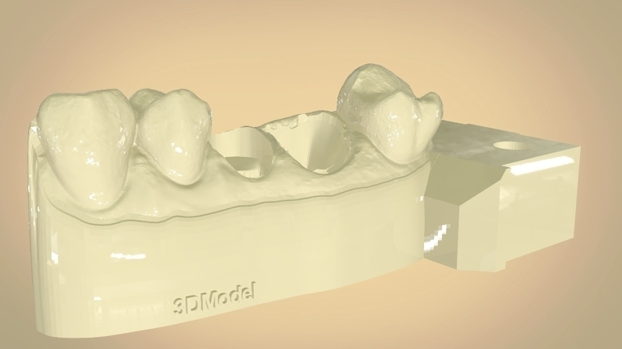 Digital Dental Quadrant Model with a Full Contour Crown 3D Print 199163 Digital Dental Quadrant Model with a Full Contour Crown 3D Print 199163