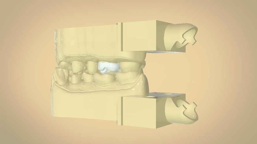 Digital Dental Quadrant Model with a Full Contour Crown 3D Print 199165 Digital Dental Quadrant Model with a Full Contour Crown 3D Print 199165