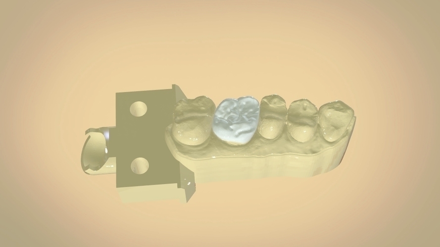 Digital Dental Quadrant Model with a Full Contour Crown 3D Print 199167 Digital Dental Quadrant Model with a Full Contour Crown 3D Print 199167