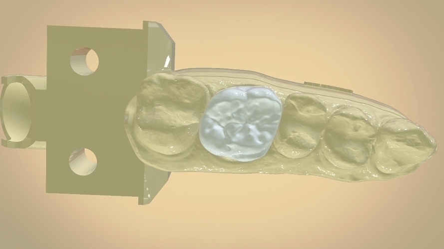 Digital Dental Quadrant Model with a Full Contour Crown 3D Print 199168 Digital Dental Quadrant Model with a Full Contour Crown 3D Print 199168