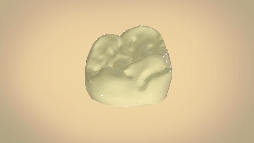 Digital Dental Quadrant Model with a Full Contour Crown 3D Print 199170 Digital Dental Quadrant Model with a Full Contour Crown 3D Print 199170