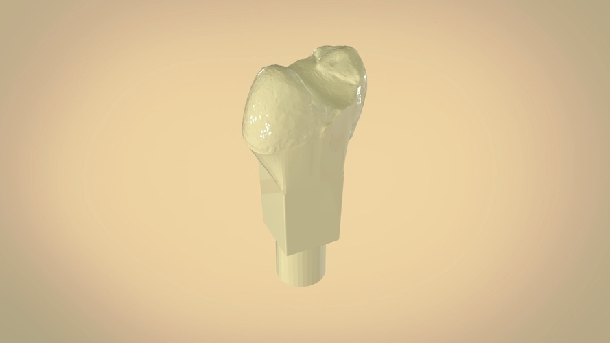 Digital Dental Quadrant Model with a Full Contour Crown 3D Print 199171 Digital Dental Quadrant Model with a Full Contour Crown 3D Print 199171