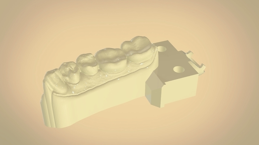 Digital Dental Quadrant Model with a Full Contour Crown 3D Print 199177 Digital Dental Quadrant Model with a Full Contour Crown 3D Print 199177