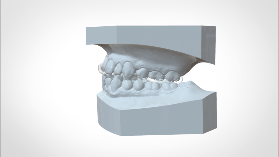 Digital KOIS Styled Nightguard 3D Print 205768 Digital KOIS Styled Nightguard 3D Print 205768