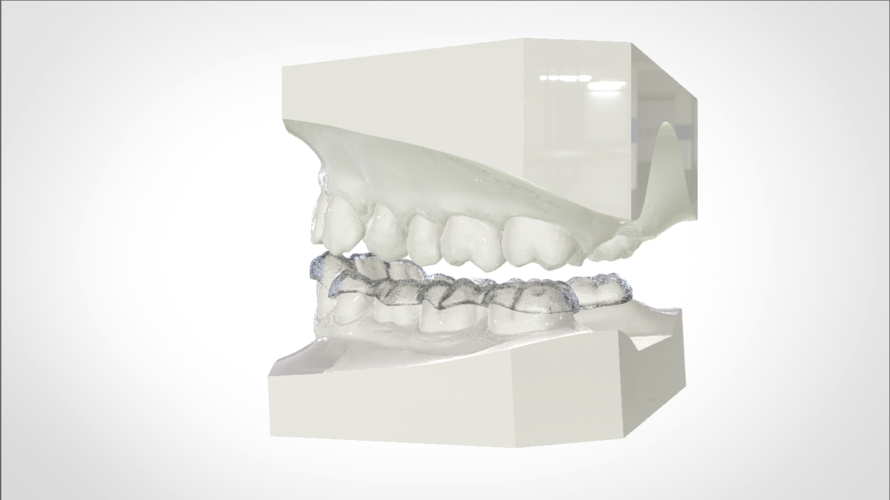 Digital Mandibular Nightguard 3D Print 207184 Digital Mandibular Nightguard 3D Print 207184