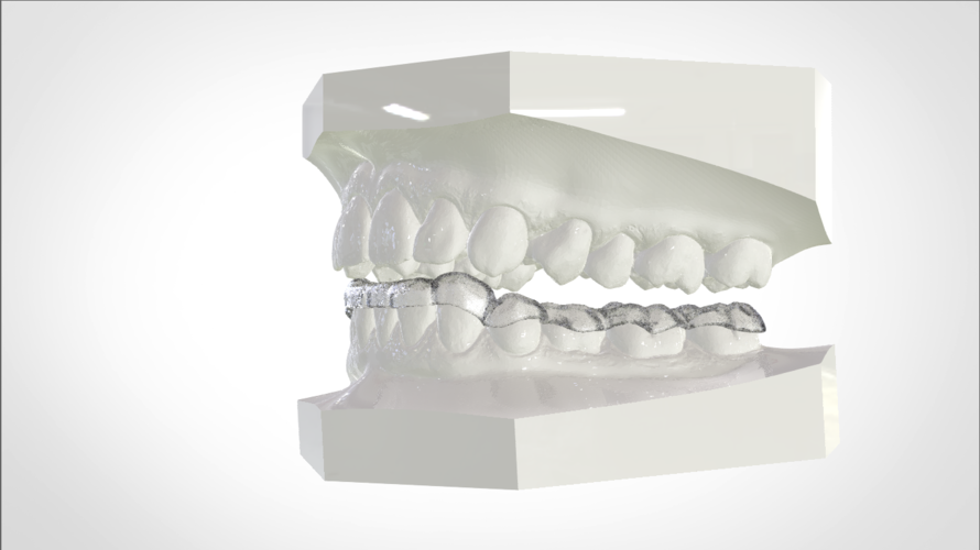 Digital Mandibular Nightguard 3D Print 207185 Digital Mandibular Nightguard 3D Print 207185