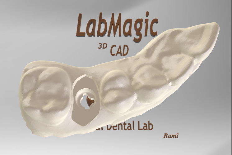 Digital Dental Implant Model with Soft Tissue 3D Print 64856 Digital Dental Implant Model with Soft Tissue 3D Print 64856