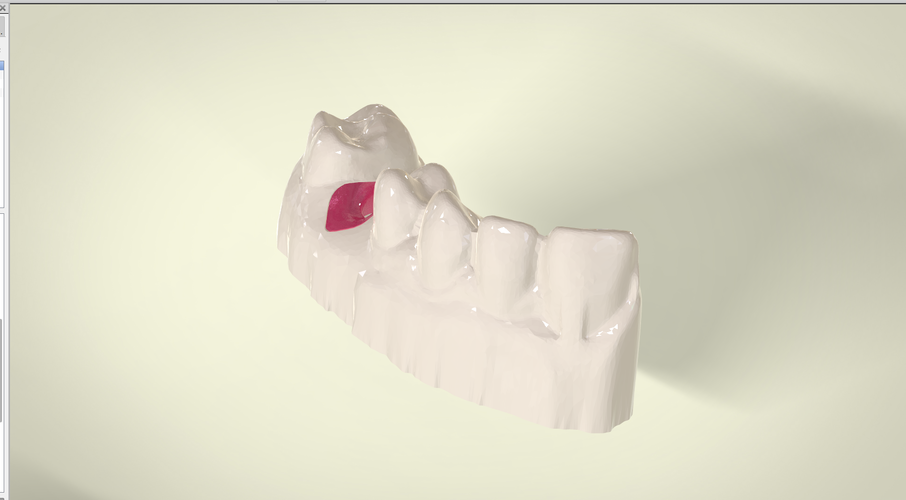 Digital Dental Implant Model with Soft Tissue 3D Print 64861 Digital Dental Implant Model with Soft Tissue 3D Print 64861