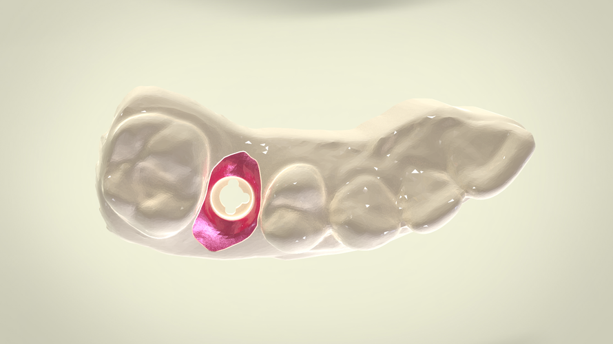 Digital Dental Implant Model with Soft Tissue 3D Print 64862 Digital Dental Implant Model with Soft Tissue 3D Print 64862