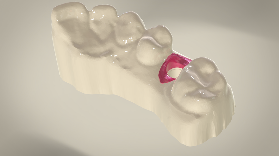 Digital Dental Implant Model with Soft Tissue 3D Print 64863 Digital Dental Implant Model with Soft Tissue 3D Print 64863