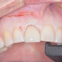 dental implant surgical guide - Thumbnail 2