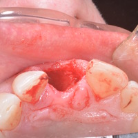 dental implant surgical guide - Thumbnail 3