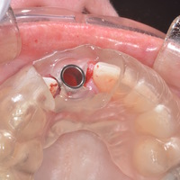 dental implant surgical guide - Thumbnail 4