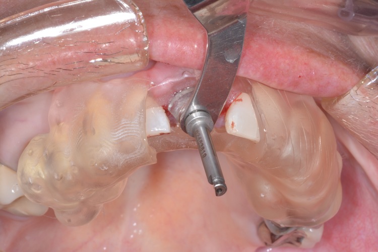 dental implant surgical guide 3D Print 115785