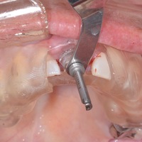 dental implant surgical guide - Thumbnail 5