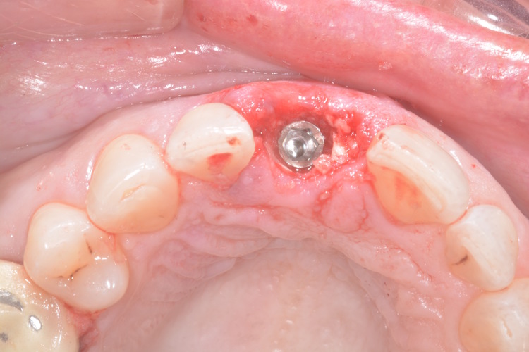 dental implant surgical guide 3D Print 115786