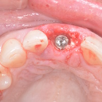 dental implant surgical guide - Thumbnail 6
