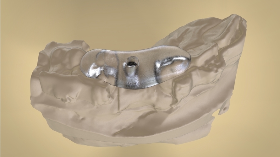 Digital Anatomical Screw Retained Abutment