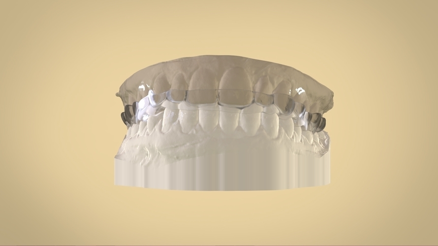 Digital Dental Bite splint