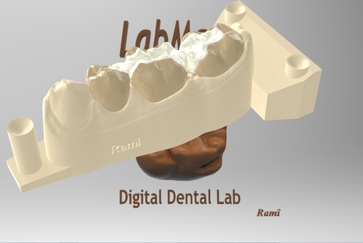 3D Printed Digital Dental Inlay Bridge Model for 3D Printing by ...