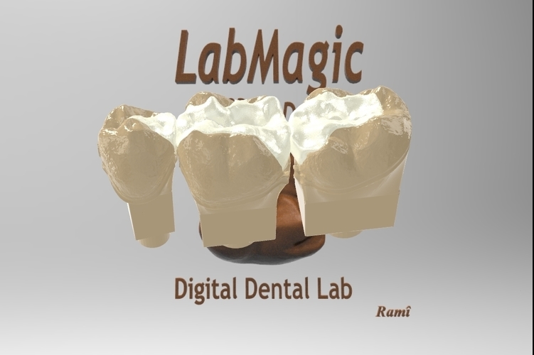 3D Printed Digital Dental Inlay Bridge Model for 3D Printing by ...